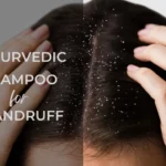 Best Ayurvedic Shampoo for Dandruff